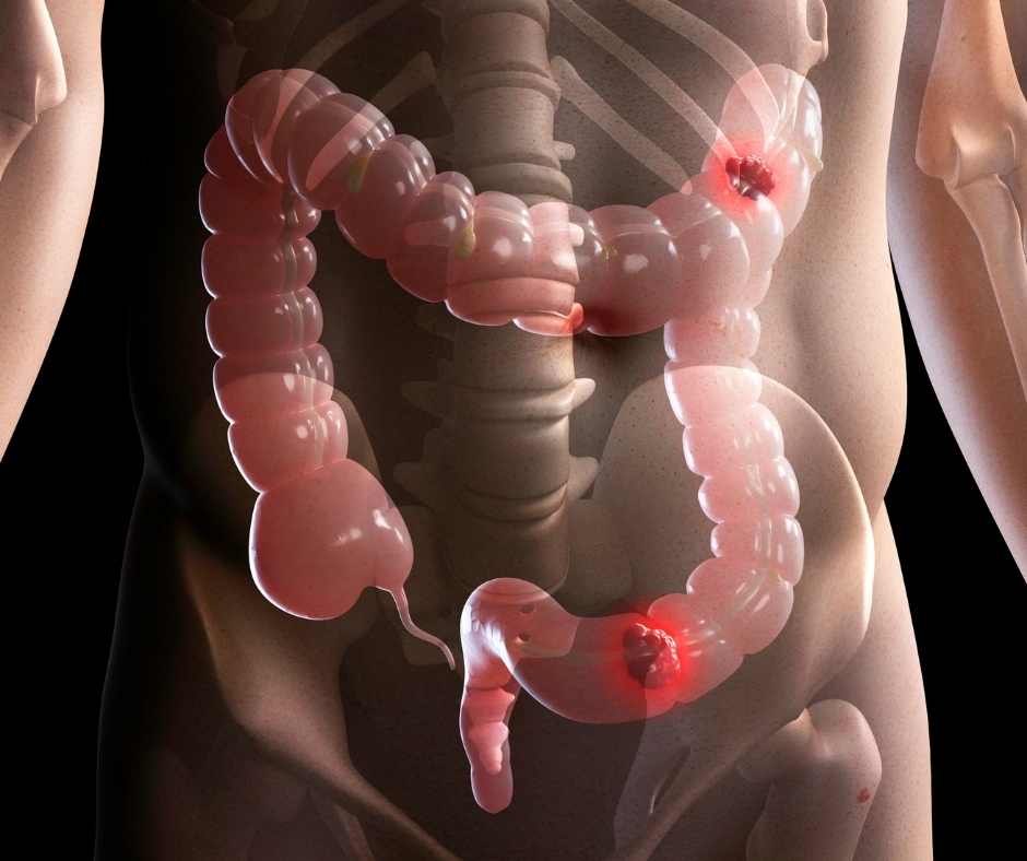 How Does Water Help With a Healthy Bowel?